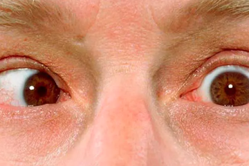   19 de Octubre 2023  
 Movimiento ocular involuntario o nistagmo 