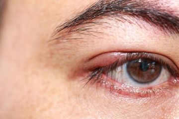   16 December 2021  
 What is a chalazion and how is it different from a stye? 