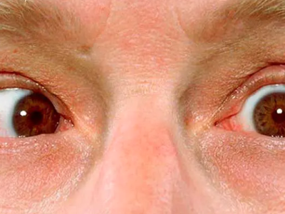 Movimiento ocular involuntario o nistagmo