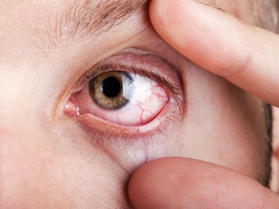 ¿Cómo afecta el síndrome de Sjögren a los ojos?