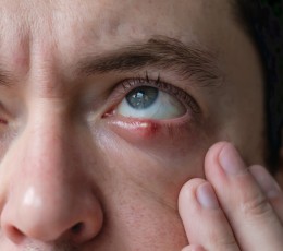 Why do styes appear?