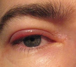 Inflammation of the eyelids, known as blepharitis