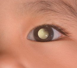 &iquest;Qu&eacute; es la leucocoria en ni&ntilde;os?