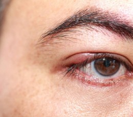 &iquest;Qu&eacute; es un chalaci&oacute;n y en qu&eacute; se diferencia de un orzuelo?