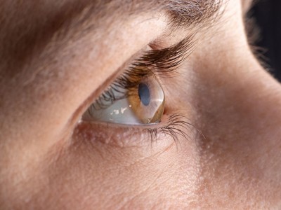 ¿Qué es el crosslinking corneal?
